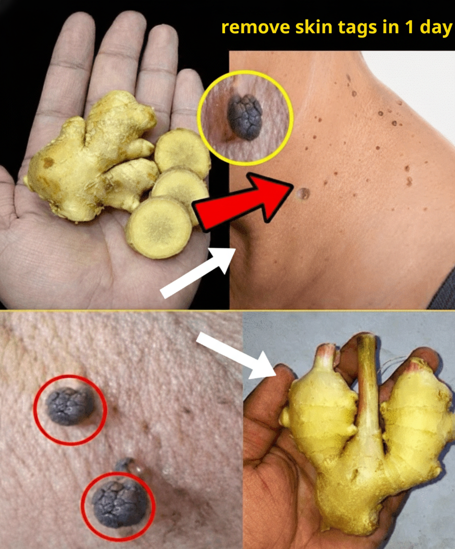 Natural Home Remedy: Tackling Skin Tags with Lemon & Ginger