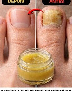 Banish Embarrassing Foot Fungus: 3 Secret Natural Remedies You Can Start TONIGHT!