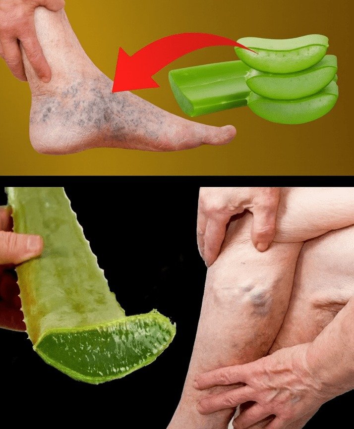 Unlocking the Potential of Aloe Vera for Varicose and Spider Veins: 10 Essential Insights