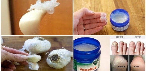 Unpacking the Vicks VapoRub and Garlic Clove Remedy: What You Need to Know for Safe Relief