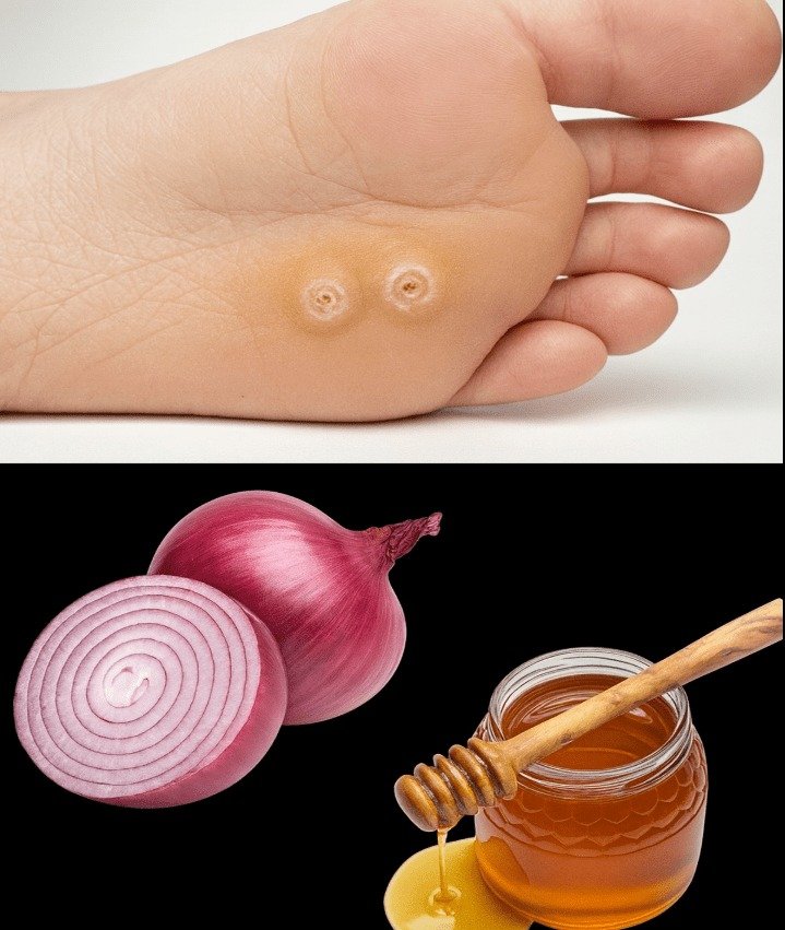 The Onion and Honey Foot Wart Remedy: A Traditional 'Before & After' Guide