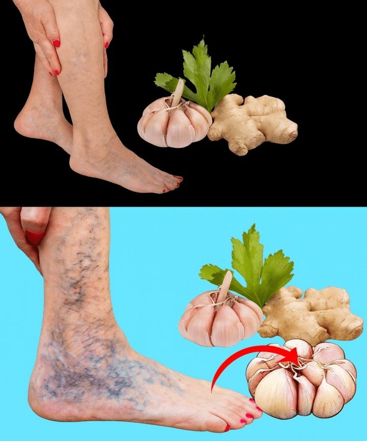 Garlic and Ginger: Potent Natural Support for Healthy Circulation and Vein Function