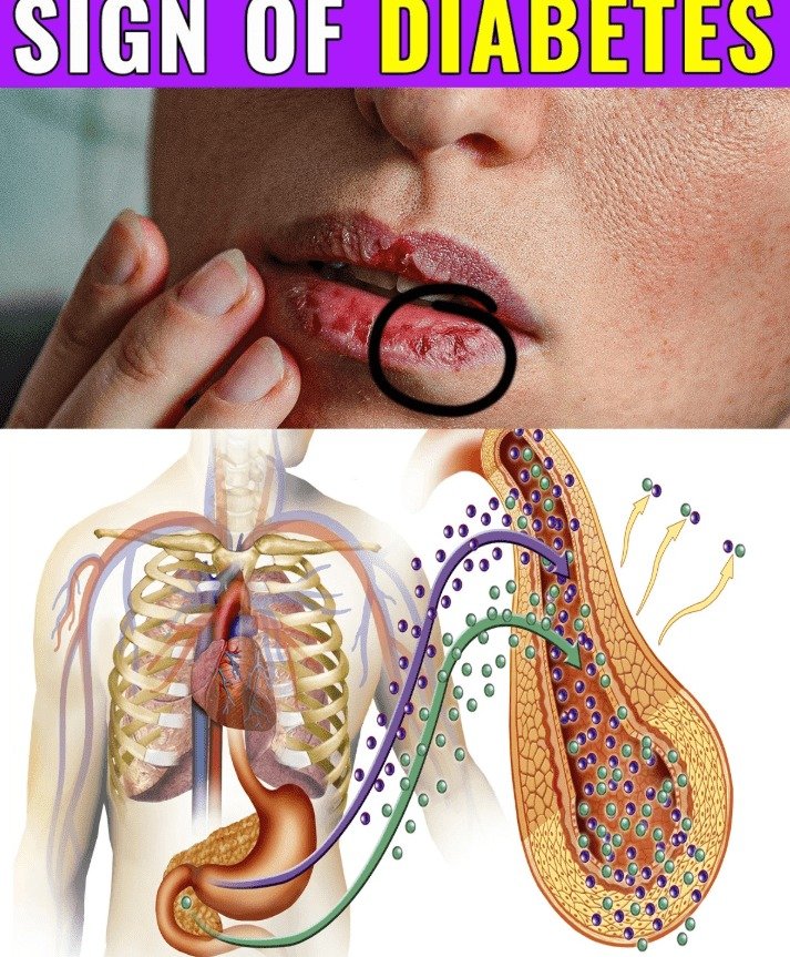 11 Unexpected Early Signs of Diabetes Many People Overlook