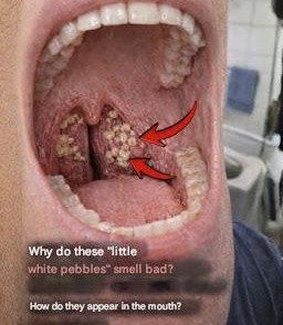 Unpacking the Mystery of Tonsil Stones: Causes, Odor, and Effective Solutions for Oral Freshness