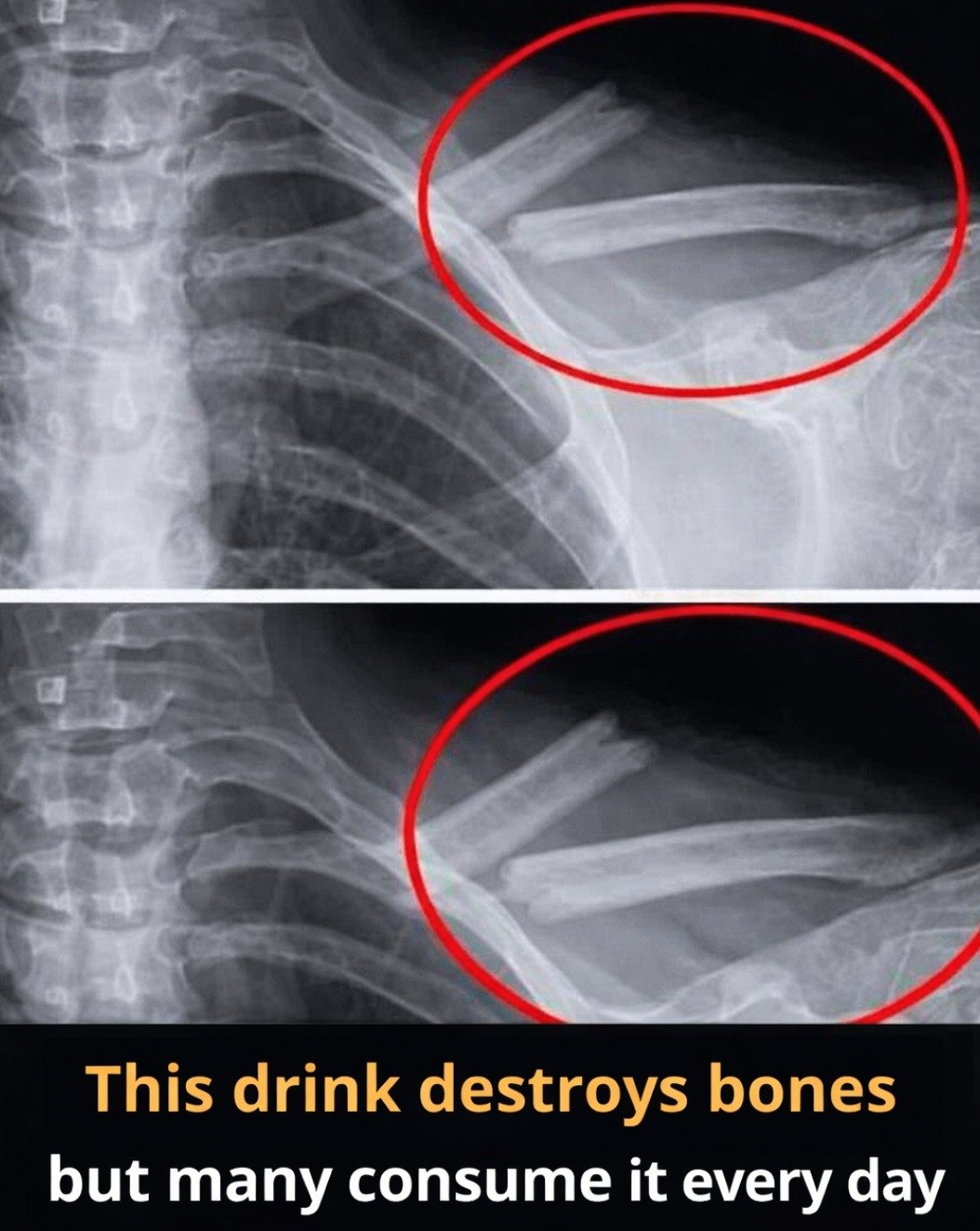 The Shocking Truth: Your Daily Soda Habit Is Secretly Destroying Your Bones and 4 Other Vital Body Systems!
