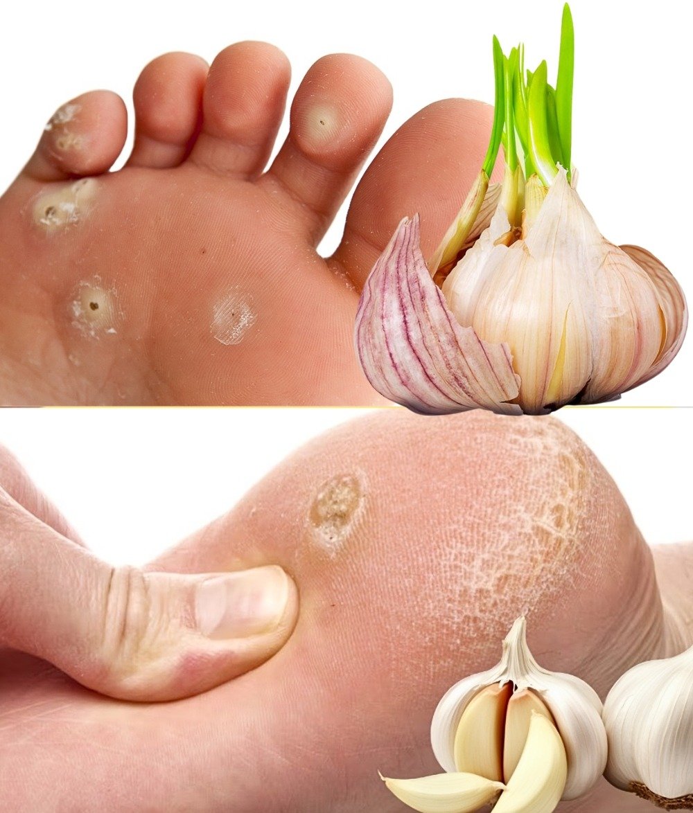 Natural and Effective Home Remedies for Eliminating Plantar Warts