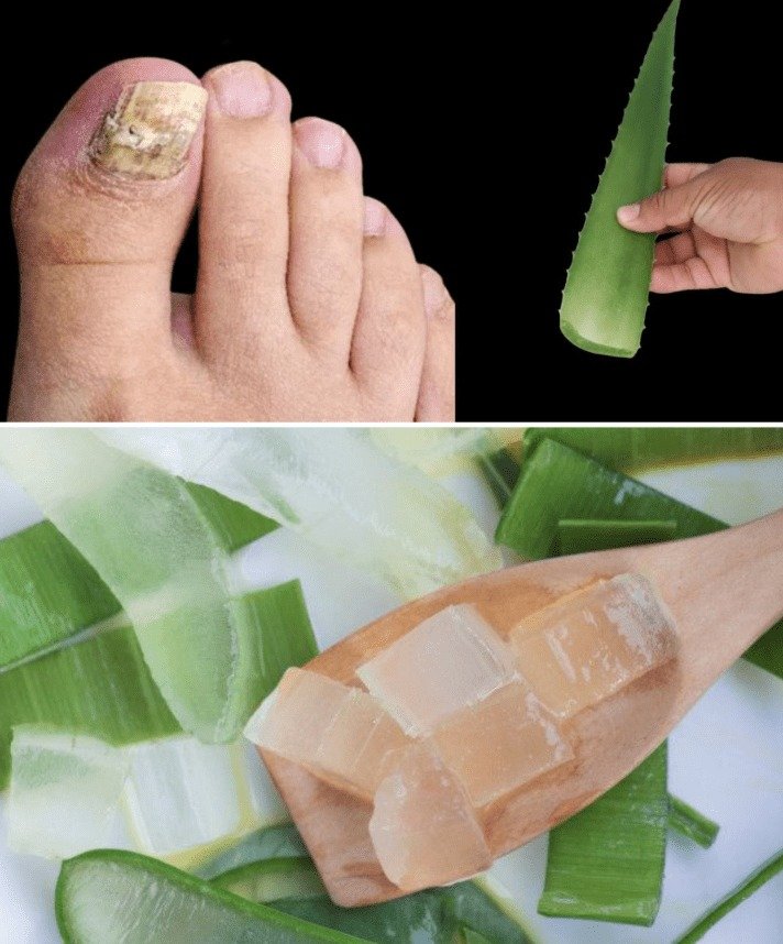 Aloe Vera for Toenail Fungus: An In-Depth Look at its Effectiveness