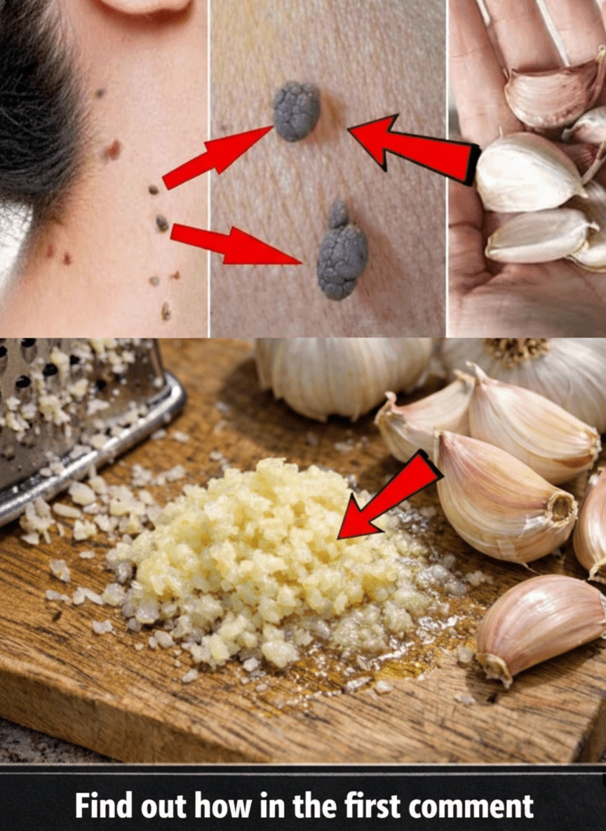 Beyond the Kitchen: Garlic's Remarkable Benefits for Skin Health and Wart Treatment