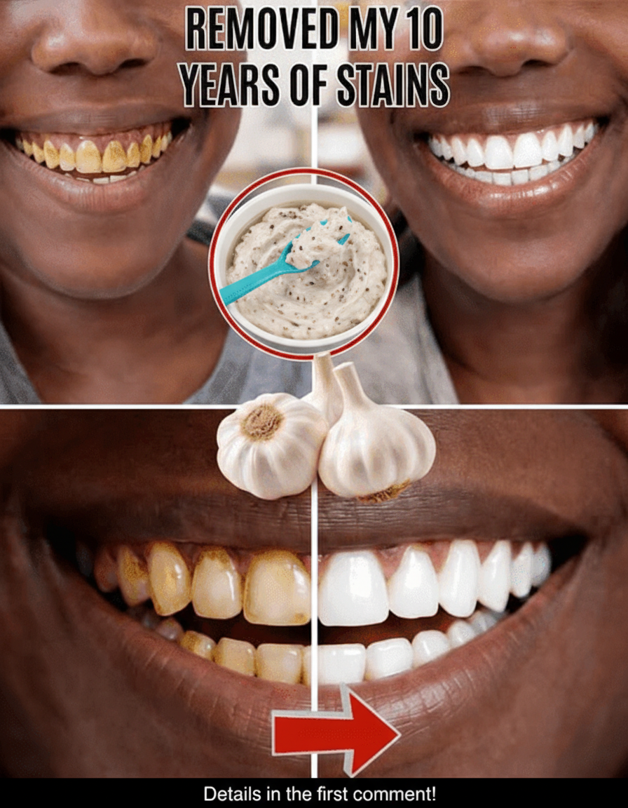 Unlocking Nature's Secret: Garlic for Enhanced Oral Hygiene and a Radiant Smile