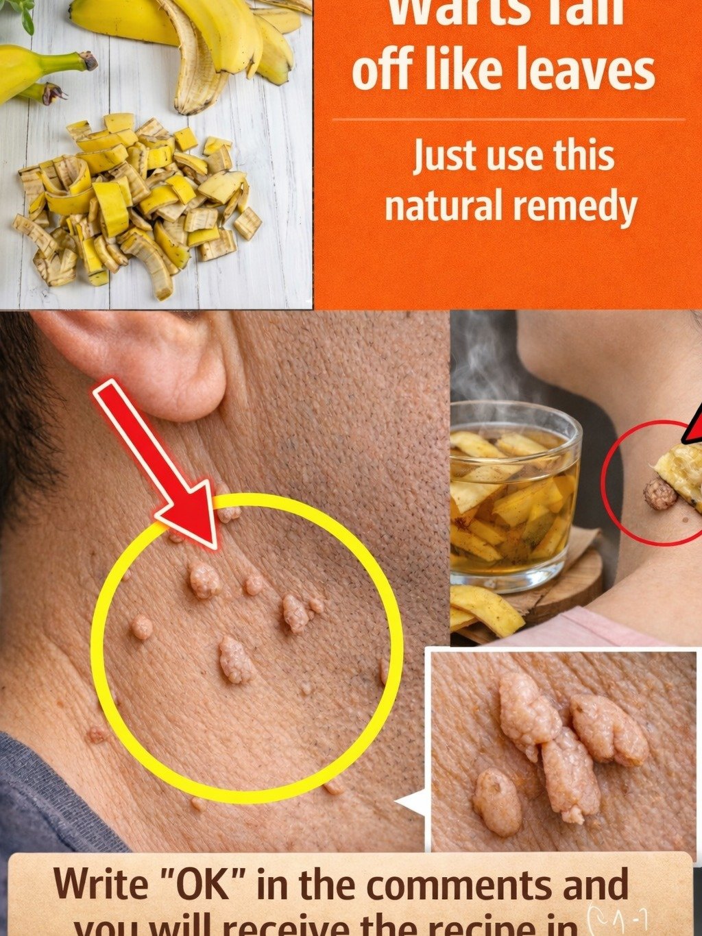 Are You Throwing Away the Secret to Clearer Skin? The Unbelievable Power of Banana Peels for Warts!