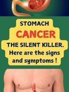 The Silent Killer Hiding in Your Gut: 8 Critical Early Signs of Stomach Cancer You MUST Know Now!