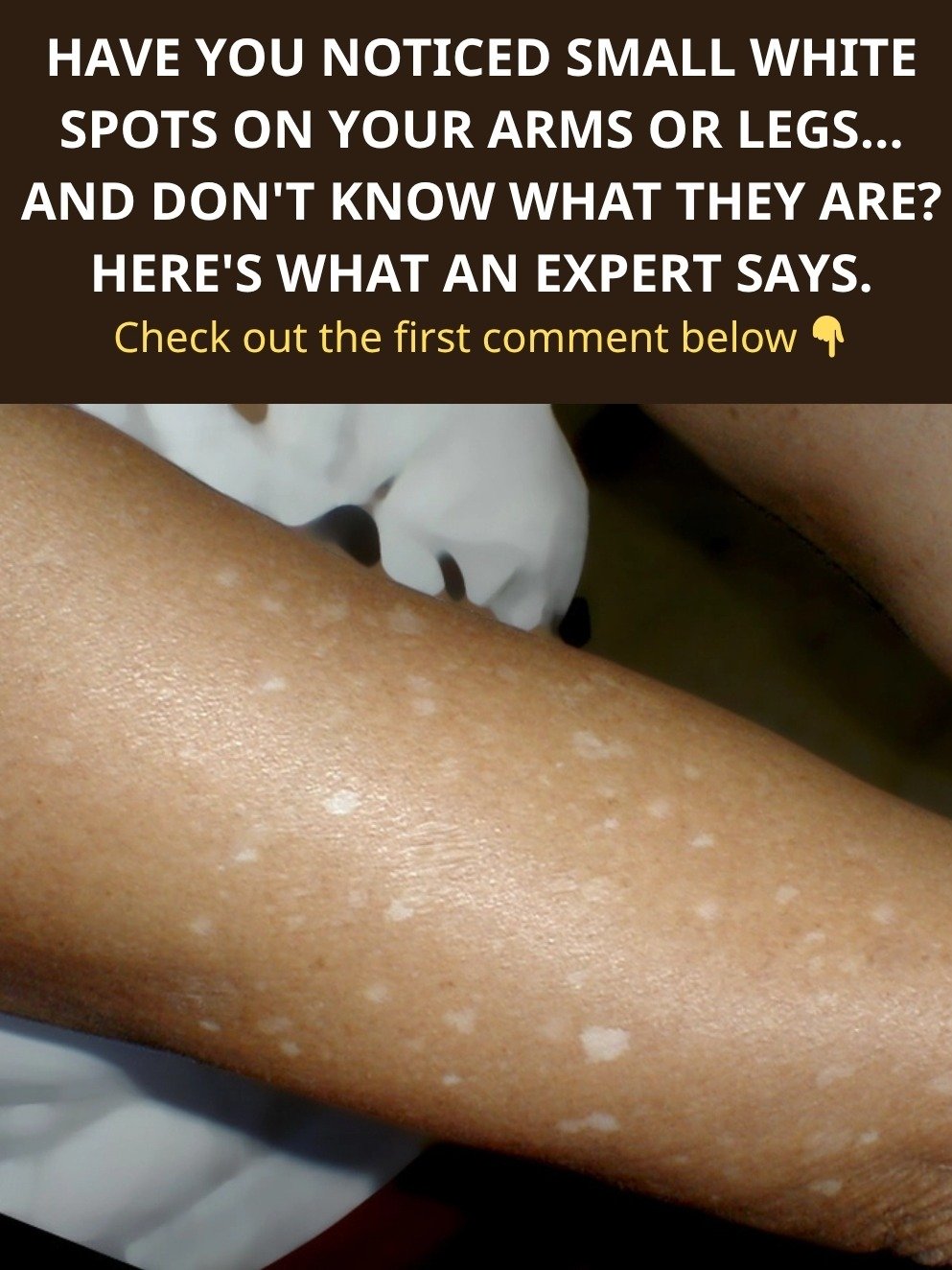 Unmasking the Mystery: What Those Small White Spots on Your Arms & Legs REALLY Mean (and How to Make Them Disappear!)