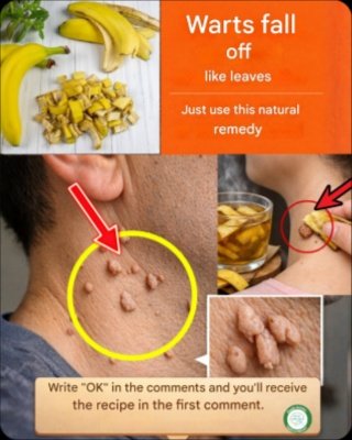 The Unbelievable Kitchen Hack: Can Banana Peels REALLY Banish Warts? What Experts Aren't Telling You!