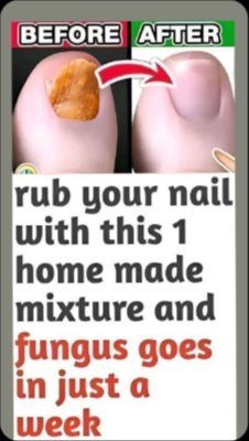 The Shocking 3-Ingredient Home Remedy That Obliterates Toenail Fungus Fast (Don't Miss This!)