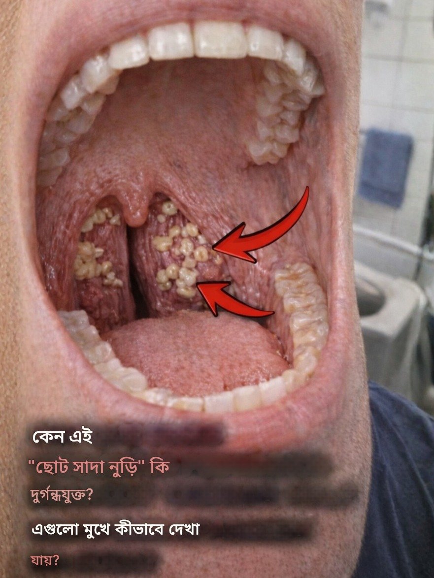 The Gross Little Secret Hiding in Your Throat: Why These White Chunks Appear & How to Banish Bad Breath for Good!