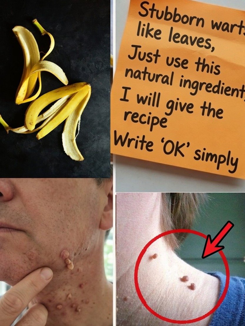 Don't Toss It! The Banana Peel Secret to Naturally Vanishing Warts (Plus 3 Other Kitchen Hacks!)