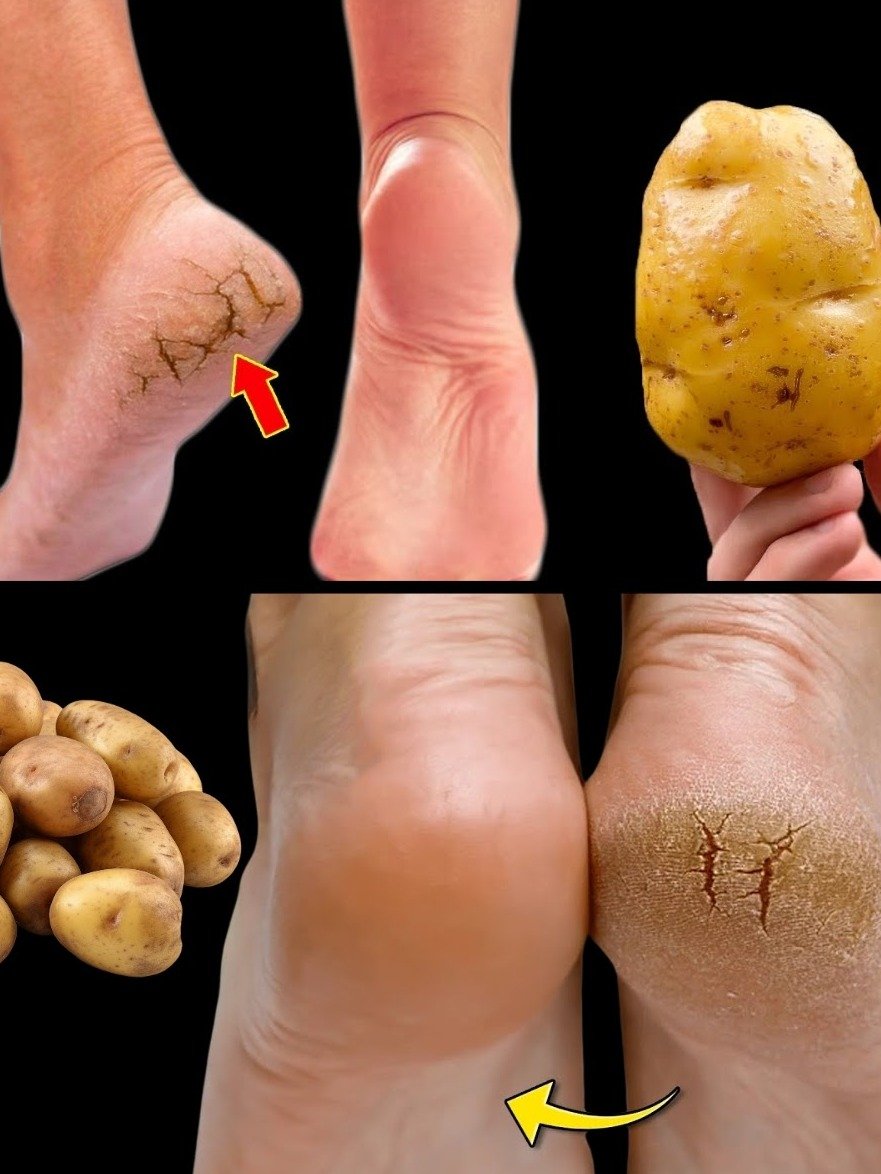 The Shocking 1-Potato Hack That Will Instantly Erase Your Cracked Heels!