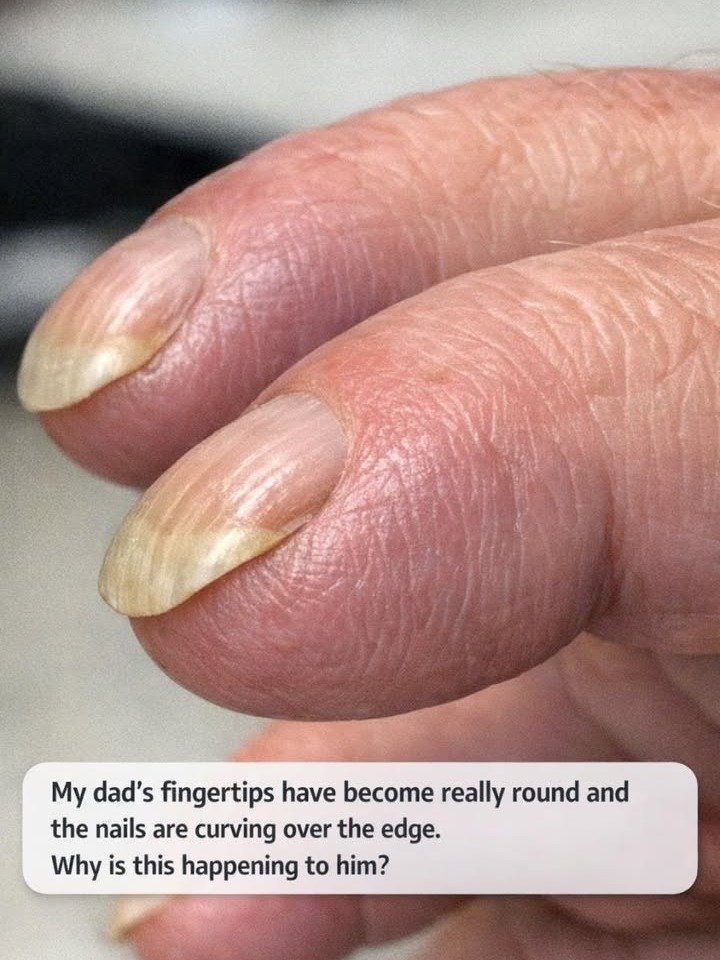 The Alarming Truth Your Curved Nails and Rounded Fingertips Are Hiding (Don't Miss This Vital Health Clue!)