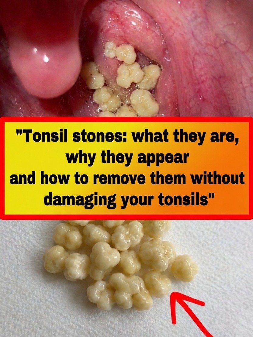 Banish Bad Breath & Throat Pain: The Shocking Truth About Tonsil Stones and 5 Safe Ways to Get Rid of Them FOREVER!