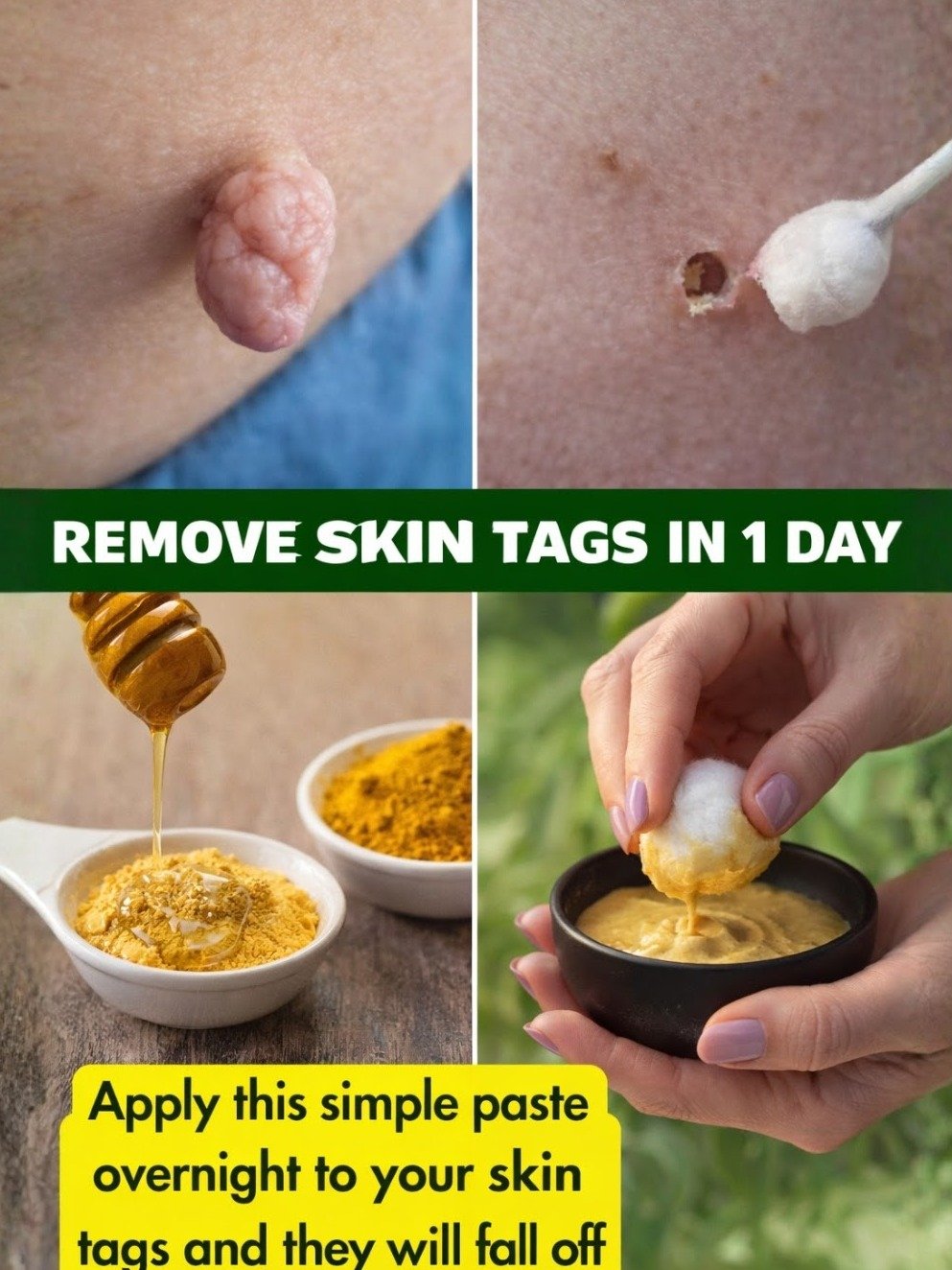 Unlock Flawless Skin: 7 Genius Natural Remedies to Make Skin Tags Vanish (Safely!)