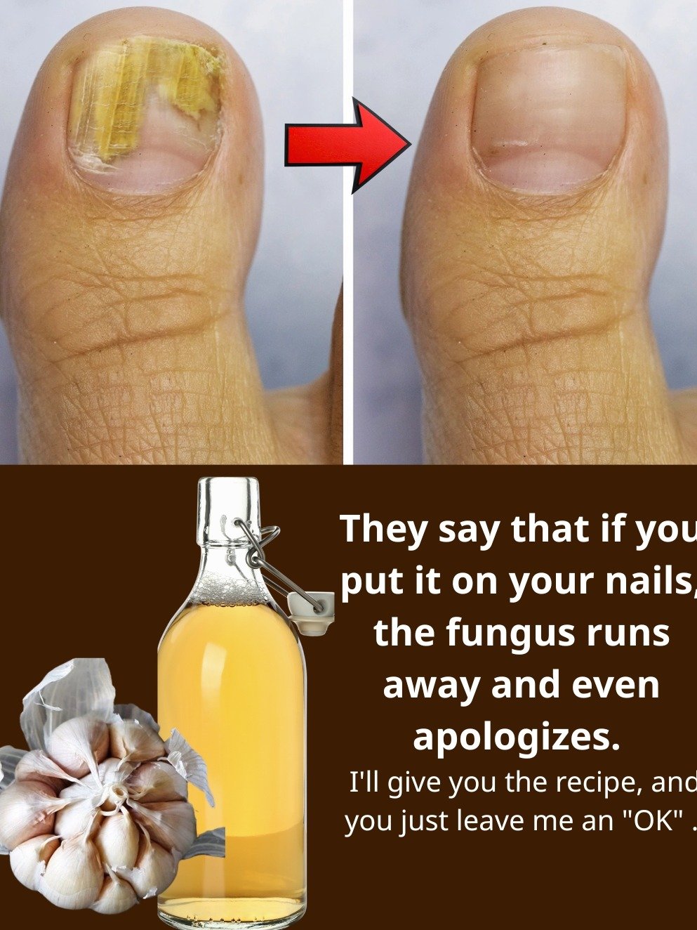 Say Goodbye to Stubborn Nail Fungus: The Viral 2-Ingredient Kitchen Hack That Actually Works!