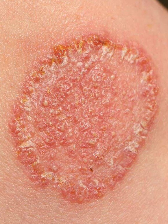 WARNING: Your Everyday Habits Are Secretly Fueling Fungal Infections! (Don't Miss These 7 Prevention Hacks)