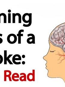 The One Hidden Stroke Sign You're Probably Missing (And Why It Could Save a Life!)