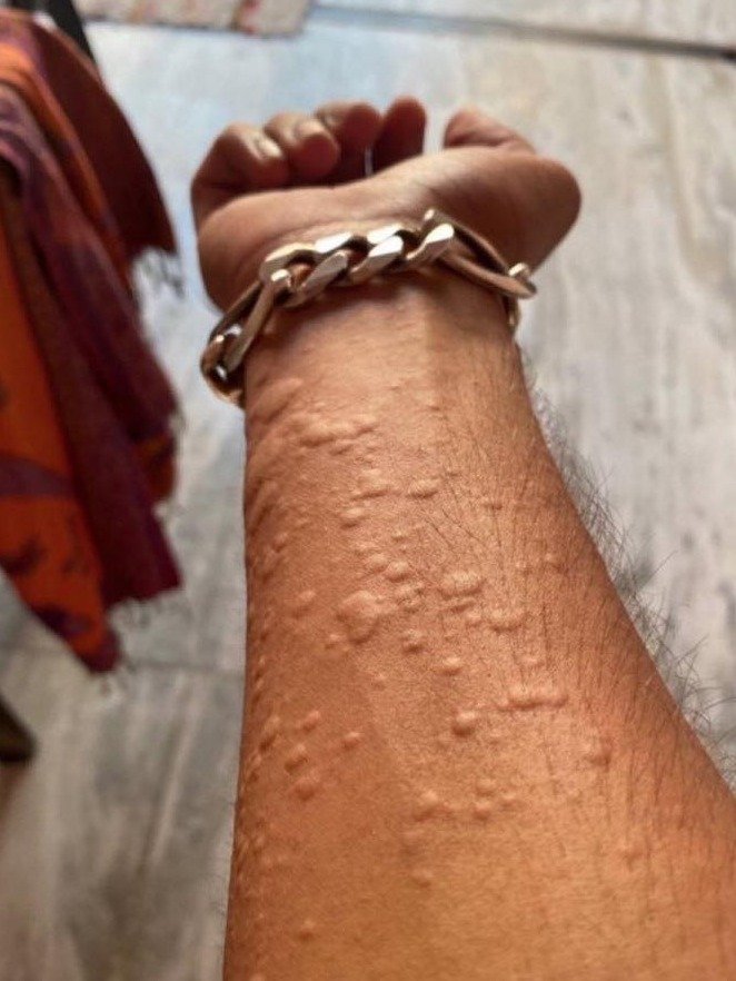 The Unbearable Itch: Why Your Skin Breaks Out in Hives (And 7 Secrets to Finally Find Relief)