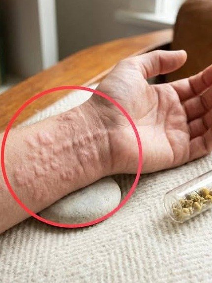 Why Do Your Hives Keep Coming Back? The Shocking Truth About Urticaria & How to Finally Find Relief