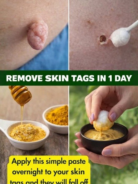 You WON'T Believe These 6 SIMPLE Home Remedies Make Skin Tags VANISH (Without a Doctor!)