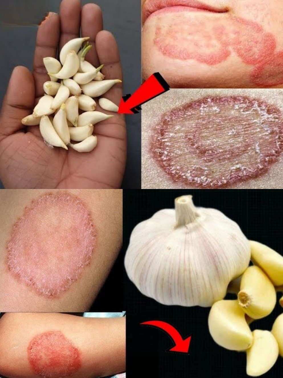 The Ancient Kitchen Secret That Could FINALLY Soothe Your Stubborn Fungal Skin Infections (Don't Miss This!)