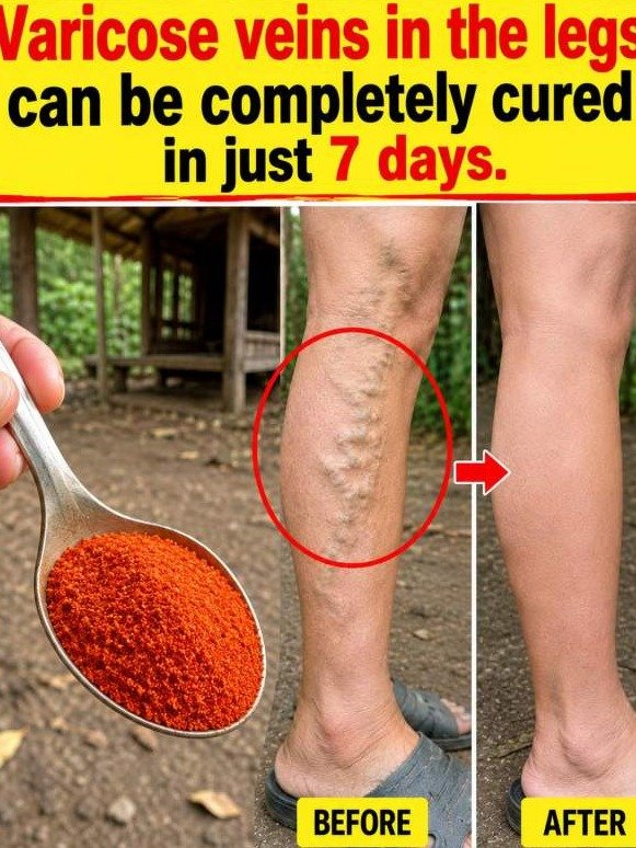 The Hidden Danger of Varicose Veins: How a Simple Kitchen Spice Unlocks a Powerful Internal Cleanup