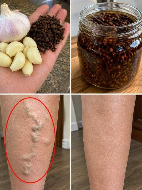 The Pantry Duo Doctors WON'T Tell You About: How Garlic & Cloves *Naturally* Cleanse Veins & End Swollen Legs!