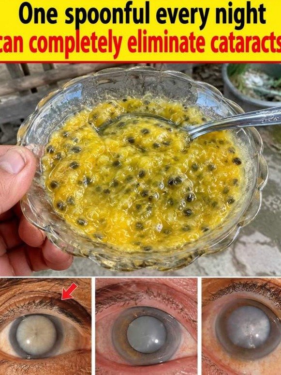 This Nightly Spoonful Clears Your Clouded Lens Overnight (Doctors Won't Tell You)