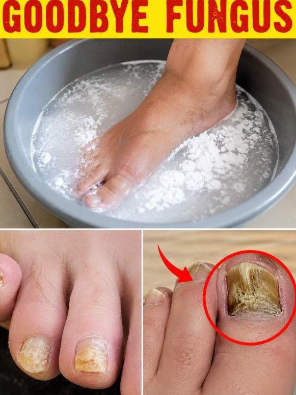 The Unseen Enemy: What Your Yellow, Thick Toenails Are REALLY Hiding (And The Simple Fix You're Missing)