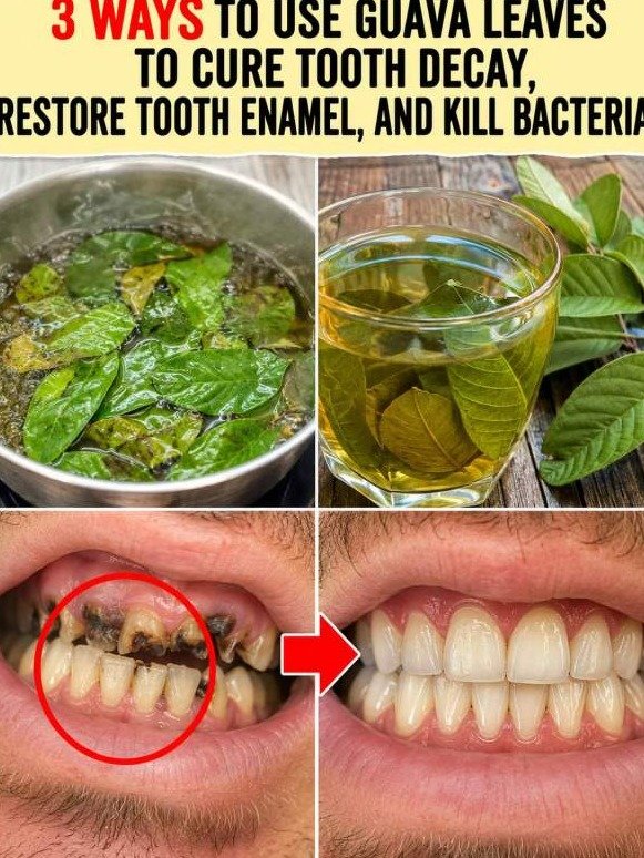 Uncover the Secret: 3 Guava Leaf Remedies That Decimate Tooth Decay and Banish Bad Breath Forever