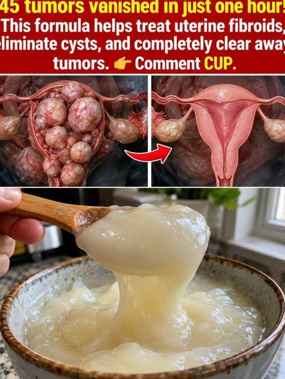Fibroids & Cysts: The Shocking Truth About The Kitchen Cup That Transforms Your Uterus (Don't Miss This!)