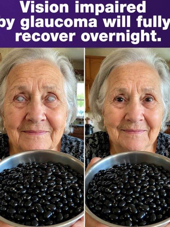 The ONE Bean That Could SAVE Your Vision Overnight: Why Black Beans Are Your Optic Nerve's Secret Weapon